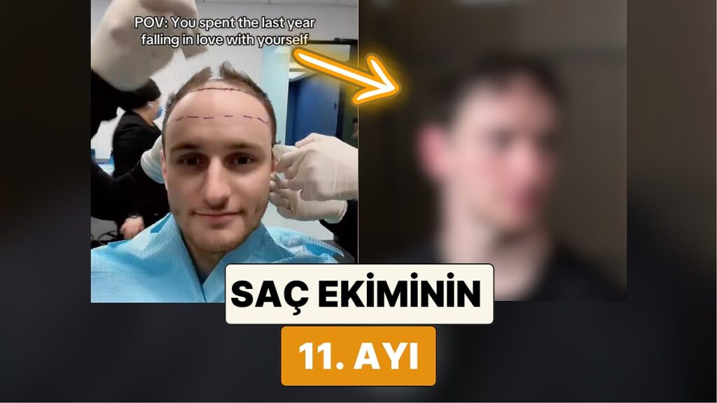 Той се превърна в напълно различен човек: Създателят на трансплантацията на коса Зеф Сандърс споделя как е изглеждала косата му след 11 месеца